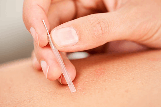 what-2 Dry Needling