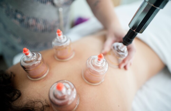Have you tried Cupping Therapy?