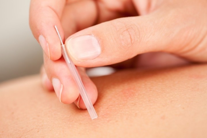 What is Dry Needling?